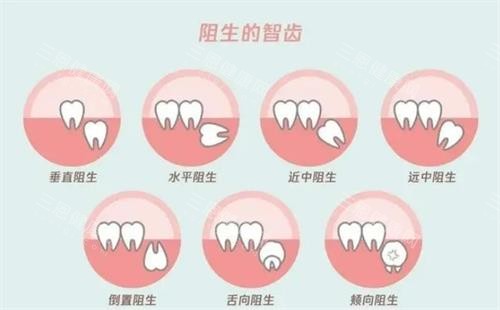 深圳拔智慧齿要几钱？2025较新收费参考价目表曝光：不同類型智齒價格從260元到8000元起！