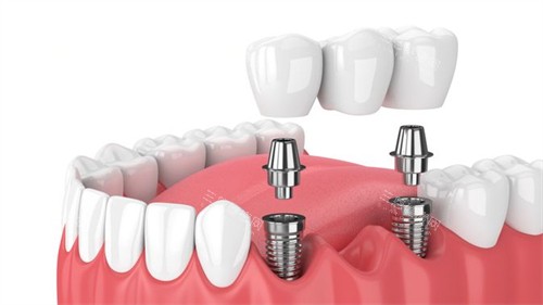 多颗种植牙图 多颗种植牙图