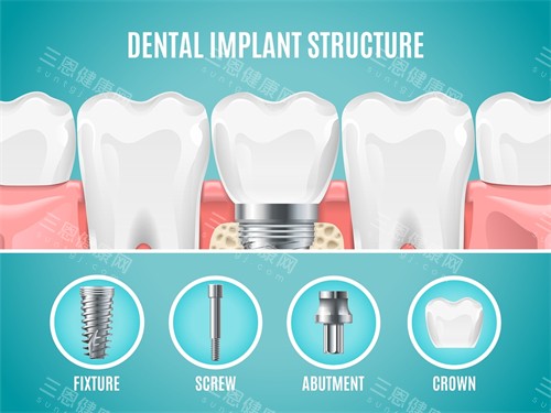 种植牙植体组成部分展示 种植牙植体组成部分展示