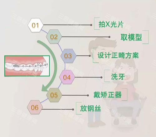 牙齿矫正流程 牙齿矫正流程