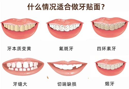 适合做牙贴面的情况