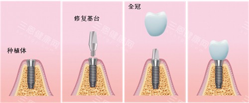 深圳元亨口腔種植牙掂唔掂？連種牙收費同核心優勢一齊講，揀得放心！