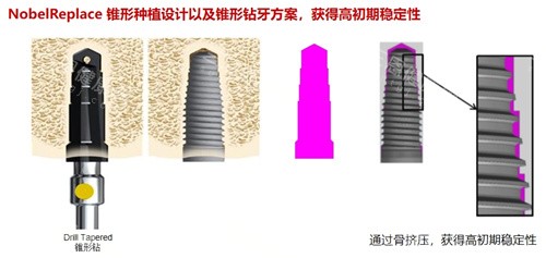 瑞典諾貝爾PCC種植體好嗎？盤點pcc種植體特點、適應症、價格及使用時間，綜合來看確實好