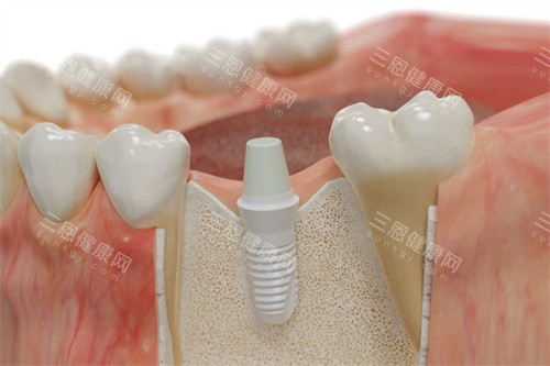 卽刻種植牙價格貴不貴？當天種牙當天用，費用、流程和優缺點全分析！
