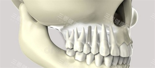 多顆種植牙多少錢？2026年種植牙價格大公開，單顆/全口費用全解析！