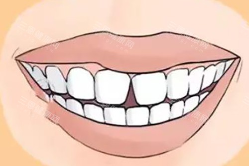 门牙有缝卡通示意图 门牙有缝卡通示意图