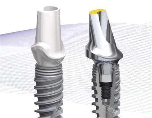 普通種植牙多少錢一顆？國產vs進口價格對比，性價比之王竟然是它！