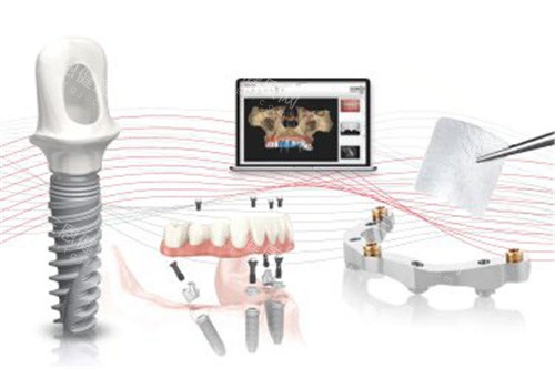 诺贝尔种植牙02 诺贝尔种植牙02