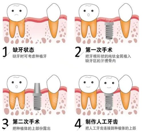种植牙后的成效 种植牙后的成效