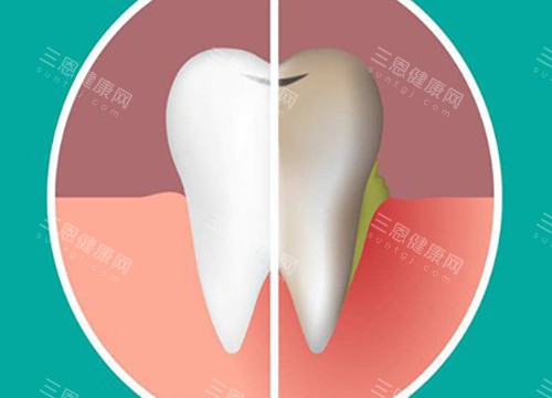 抽煙牙齒變黃怎麼變白？建議選擇做牙齒美白，冷光美白及牙貼面成效顯著