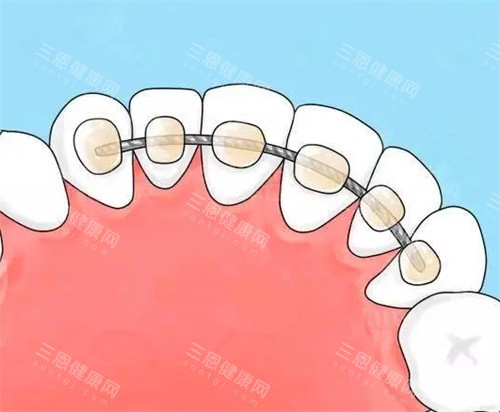 舌侧保持器漫画示意图