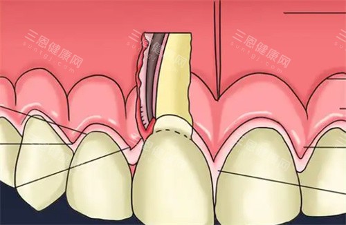深圳牙周病治疗要几钱？不同医院收费差异惊人，多种治疗方式的费用明细全在这，别花冤枉钱啦！