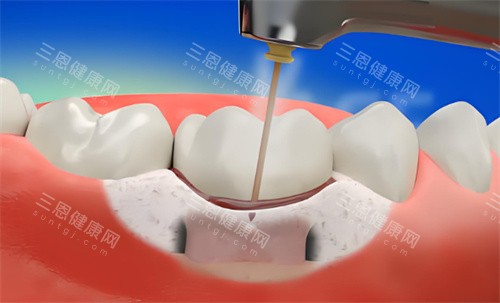 牙周炎激光治疗