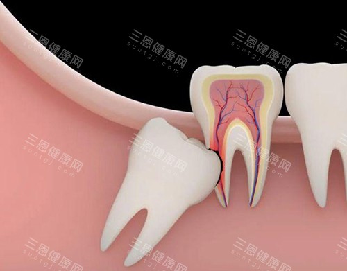 深圳猛智齿痛唔痛？揭秘深圳智齿拔除流程，对比不同情况的疼痛差异，结合实例提前做好准备！