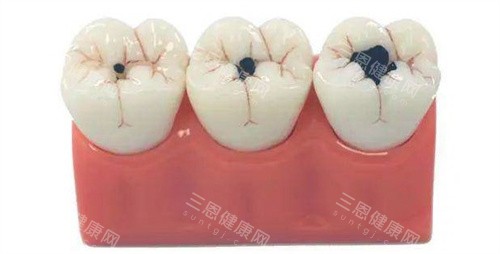 补牙的大小对比 补牙的大小对比