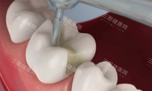 嵌体补牙过程 嵌体补牙过程