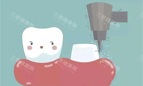 根管治療和種植牙哪個結果好？牙醫揭秘：不同牙齒問題適合不同修復方式！