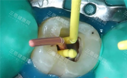 根管治疗手术过程图