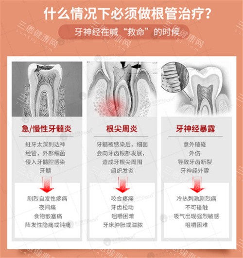 适合做根管治疗的情况