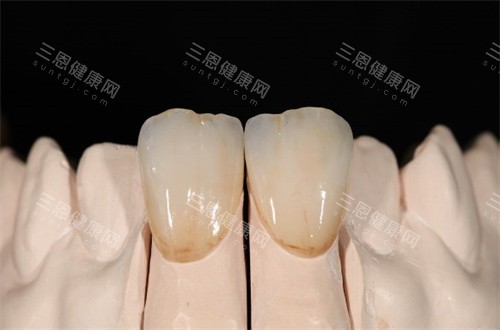 铸瓷冠