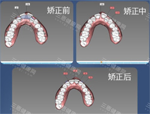 牙齿矫正设计图