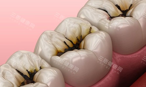 怎么区分小孩到底是牙菌斑还是龋齿？从形成时间到危害程度，这5点区别帮你看清～