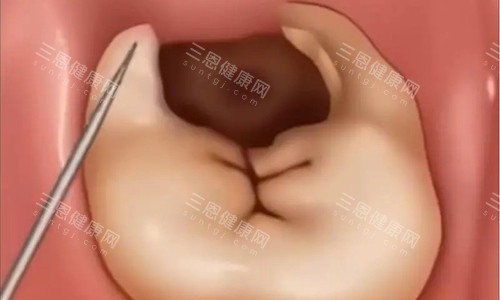 牙齿龋齿卡通图