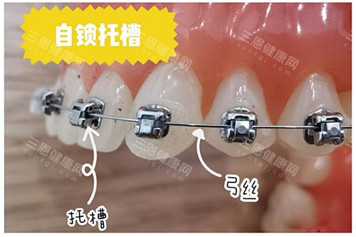 牙齿矫正自锁托槽牙套