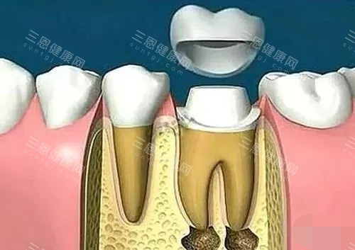 根管治療後一定要做牙冠嗎？看醫生和5位牙友親身經歷怎麼説