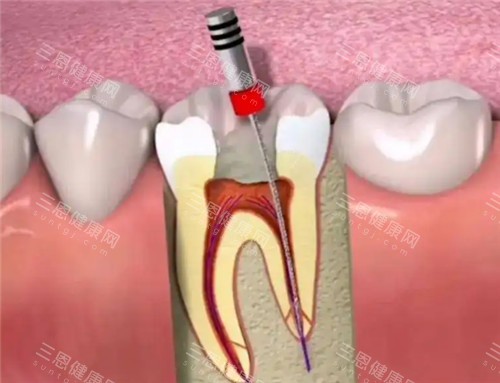 根管治疗动画模拟图