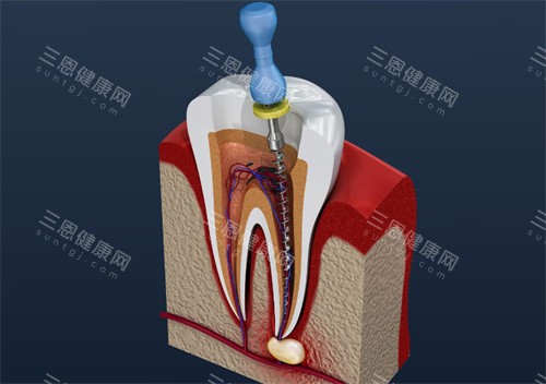 根管治疗中的牙齿