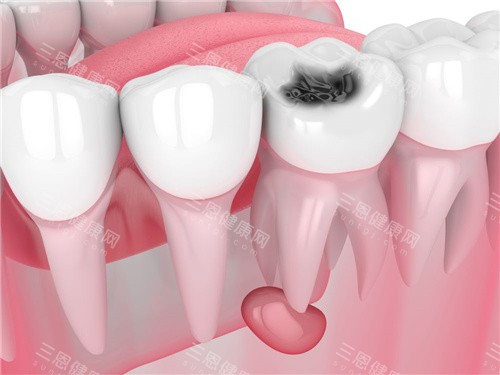 牙齿根管囊肿 牙齿根管囊肿
