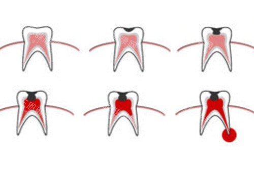 牙齿疼痛内部示意图 牙齿疼痛内部示意图