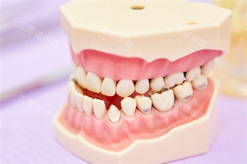 反颌牙齿模型 反颌牙齿模型