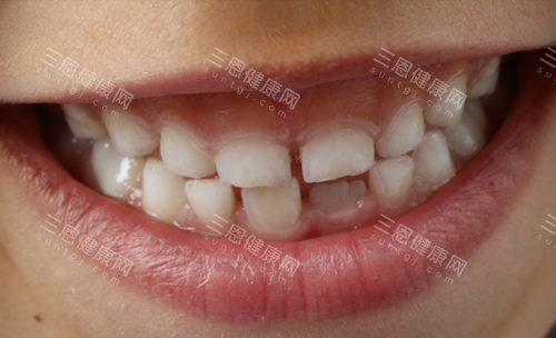牙齿不齐 牙齿不齐