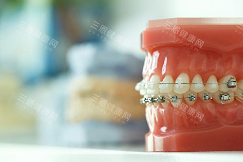 香港人必睇！金屬、陶瓷定係隱形牙套點樣揀適合你？