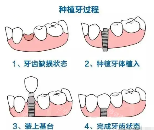 深圳正恩向西口腔點樣？靠譜嗎？資質、看牙技術同顧客評價大分享！