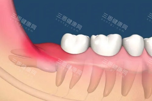 智齿发炎卡通体 智齿发炎卡通体