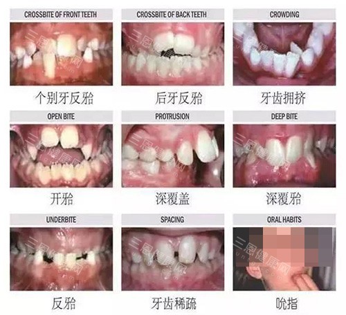 牙齿矫正不同类型的适应症 牙齿矫正不同类型的适应症