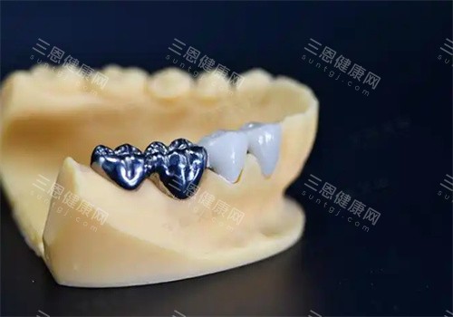 纯钛一体冠牙齿
