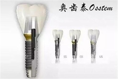 深圳新大地口腔種植牙靠譜嗎？當然！佢哋做種植牙夠專業，仲會清晰講明種牙多少錢，放心揀！