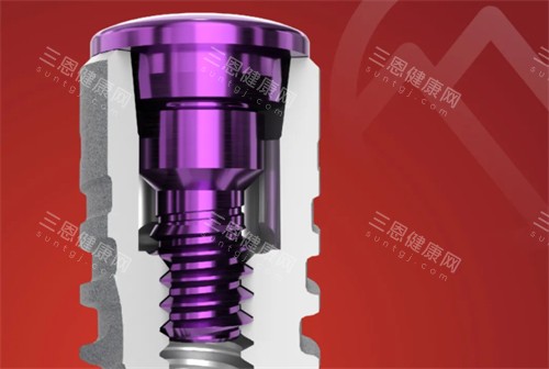 卡爾斯種植牙價格表公佈：8000~12000元不等，卡爾斯屬於中高端檔次植體使用時間久口碑也好