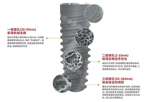 卡尔斯种植牙表面技术 卡尔斯种植牙表面技术
