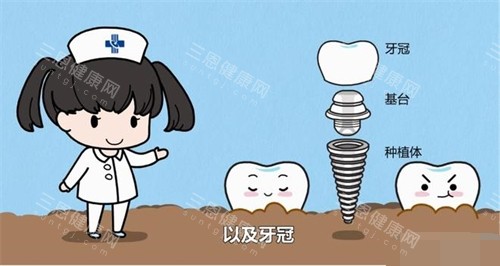 深圳种植牙价格对香港人便宜吗？从品牌到附加费|拆解韩系/欧美系植体差价|医疗券能抵2000港币！