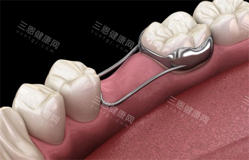 牙齿间隙保持器 牙齿间隙保持器