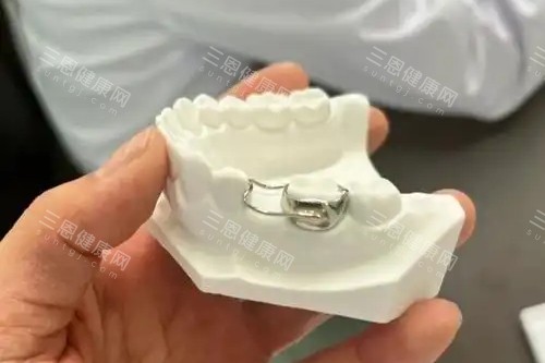 儿童牙齿间隙保持器 儿童牙齿间隙保持器