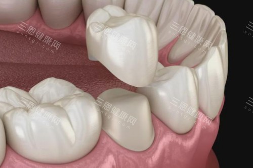 牙齿镶牙卡通图片展示 牙齿镶牙卡通图片展示