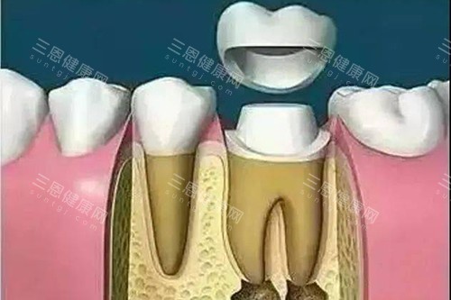 根管治疗后安装牙套 根管治疗后安装牙套