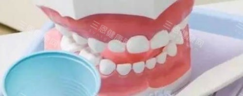 活動假牙和固定假牙哪種更適合老年人？沒有更適合的，需按照口腔條件選擇