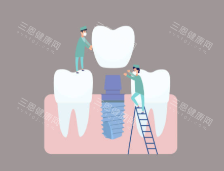 种植牙检查示意图